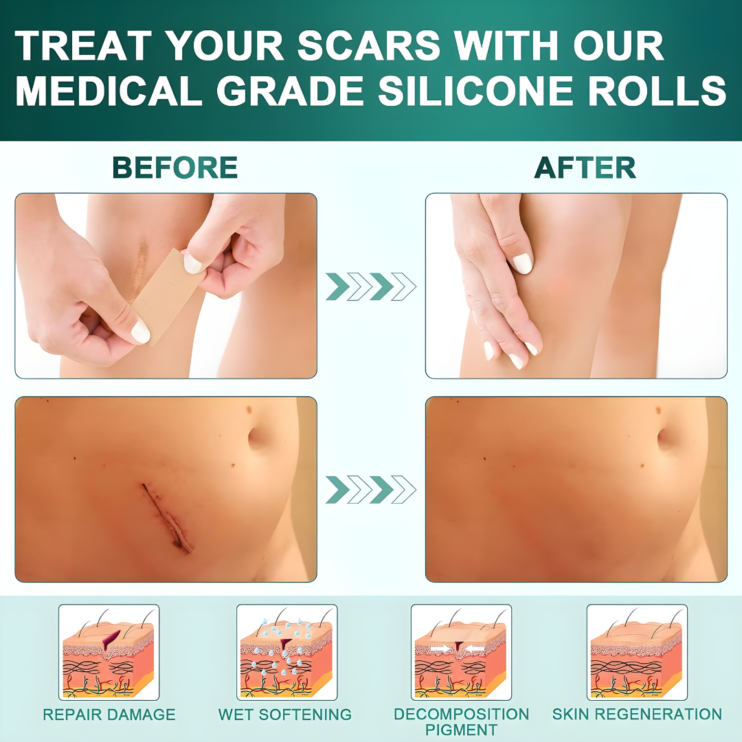 Silicone Scar Sheets